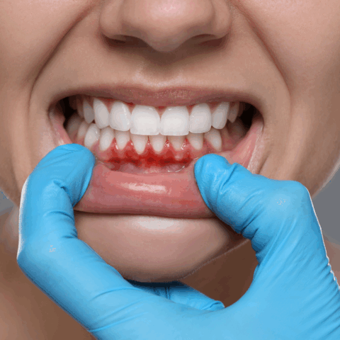 ¿Sabías que tener el sangrado en las encías y la movilidad dental podría provocar un parto prematuro?