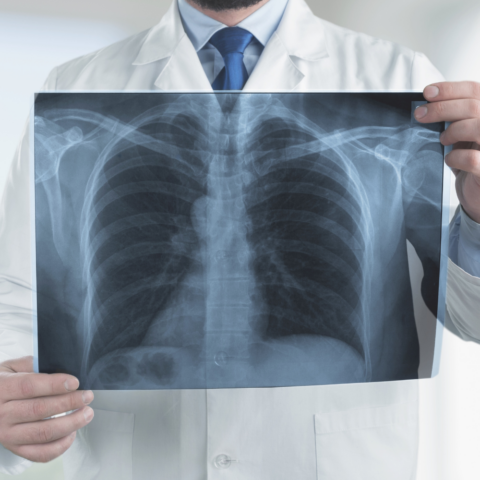 Fibrosis quística: Un diagnóstico olvidado en pacientes con infecciones respiratorias recurrentes