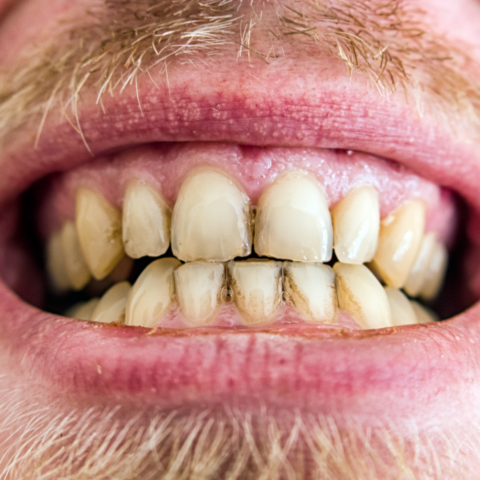 Sonrisas afectadas: Todo sobre la fluorosis dental