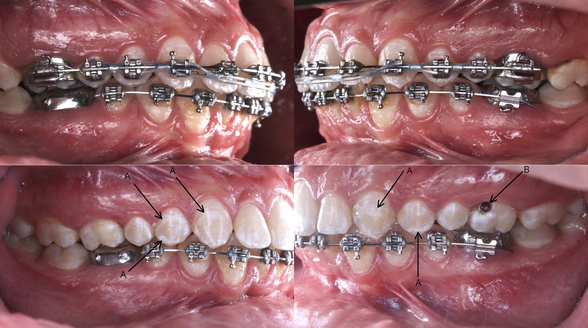 Los Brackets Manchan Los Dientes Con Evidencia Plus Los Brackets Manchan Los Dientes Con Evidencia Plus
