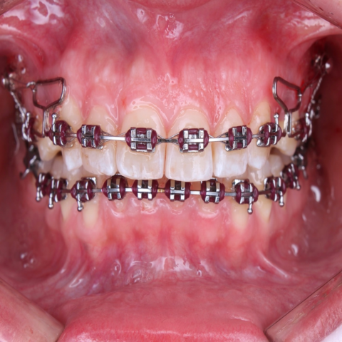 ¿Los brackets manchan los dientes?