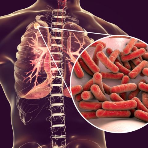 La paradoja de la tuberculosis: ciencia, historia y desigualdad en el siglo XXI