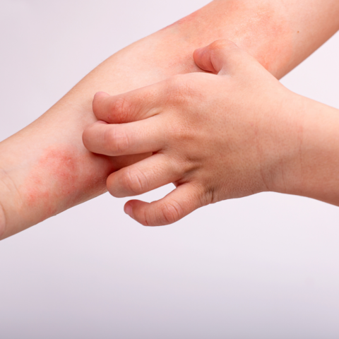Dermatitis atópica: vivir con una piel que no descansa