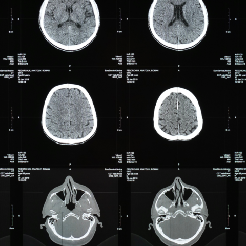 Inflamación cerebral tras un traumatismo craneal: un daño que progresa