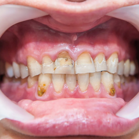 Fluorosis dental: cuando el exceso de flúor deja huella en el esmalte